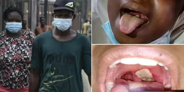 Diphtheria: FCT And 19 States To Bring Back Use Of Face Masks